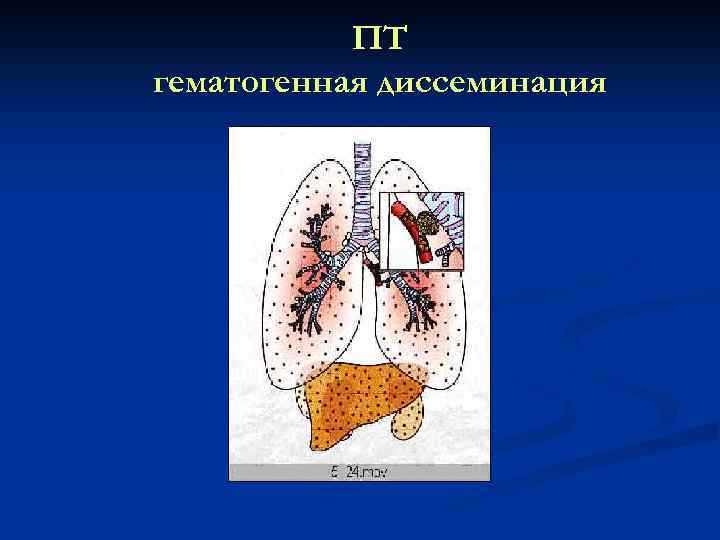 ПТ гематогенная диссеминация 