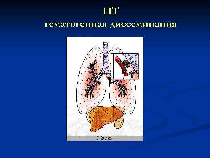 ПТ гематогенная диссеминация 