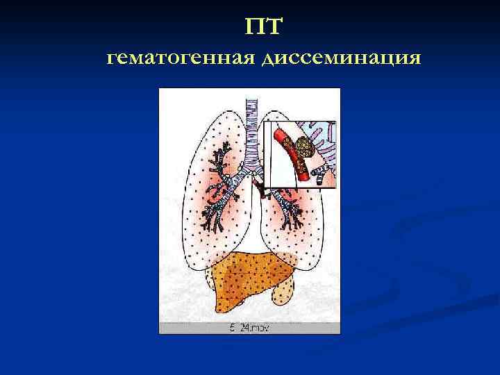 ПТ гематогенная диссеминация 