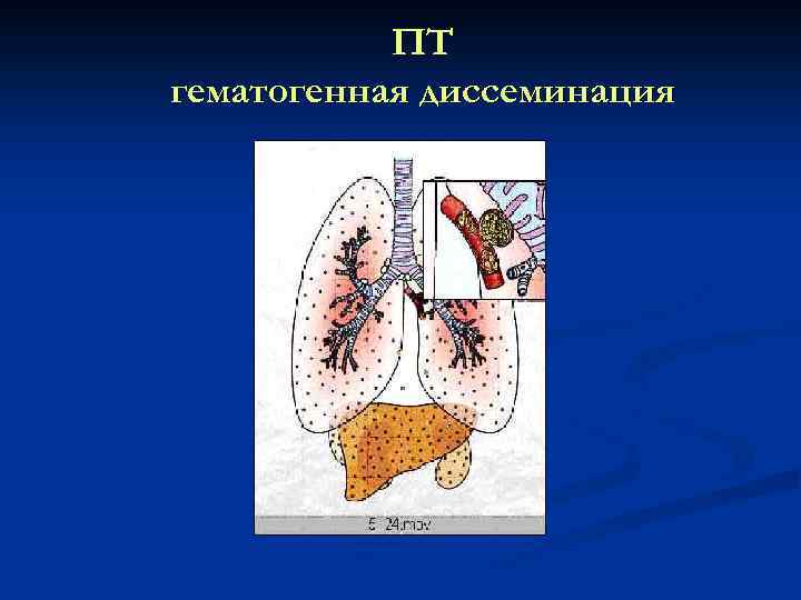 ПТ гематогенная диссеминация 