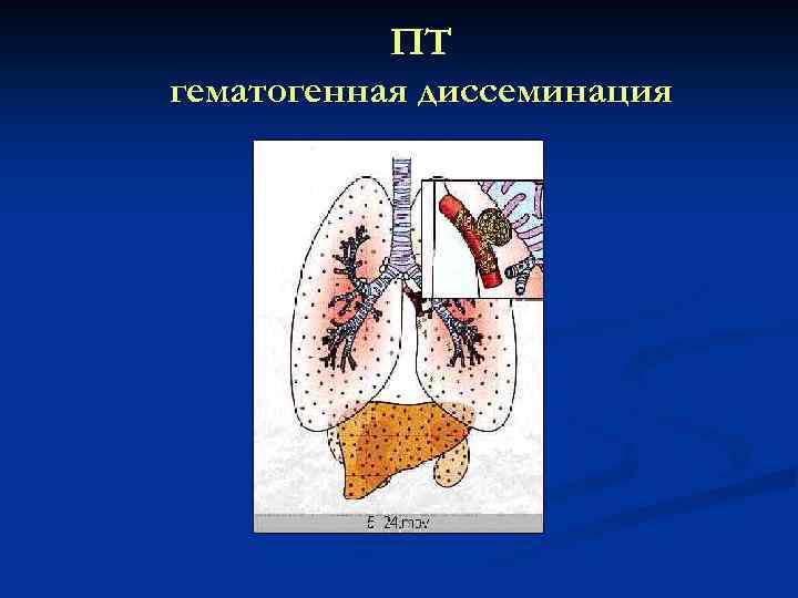 ПТ гематогенная диссеминация 