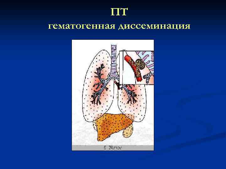 ПТ гематогенная диссеминация 
