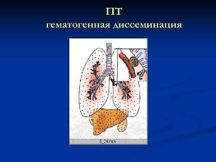ПТ гематогенная диссеминация 