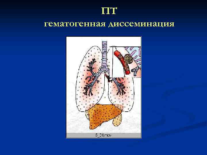 ПТ гематогенная диссеминация 