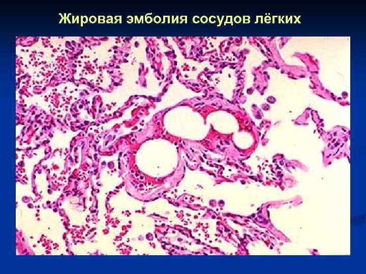Жировая эмболия сосудов лёгких 