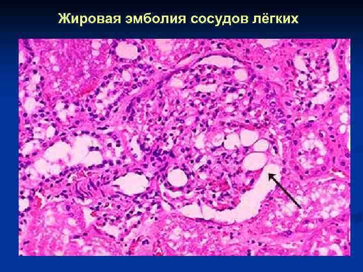 Жировая эмболия сосудов лёгких 