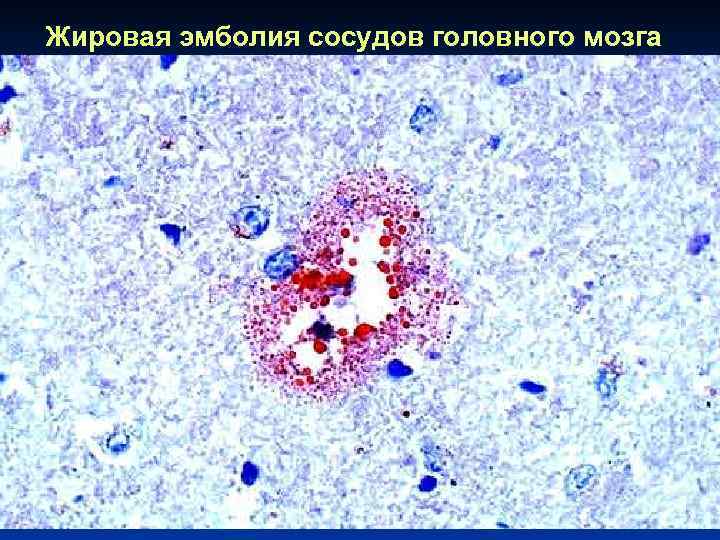 Жировая эмболия сосудов головного мозга 