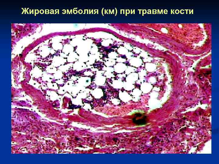 Жировая эмболия (км) при травме кости 