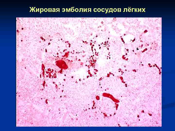 Жировая эмболия сосудов лёгких 