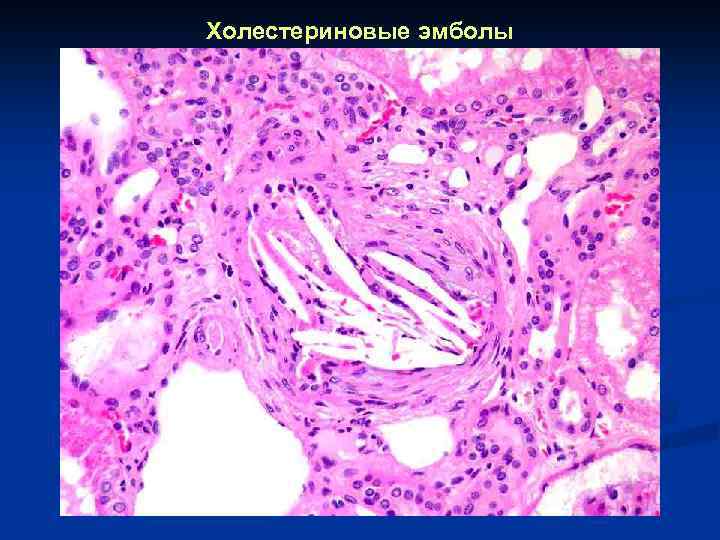 Холестериновые эмболы 