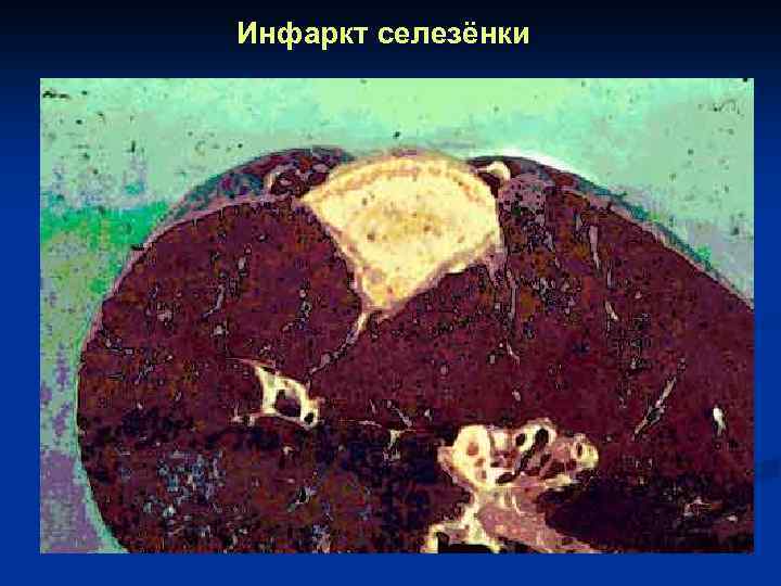 Инфаркт селезёнки 