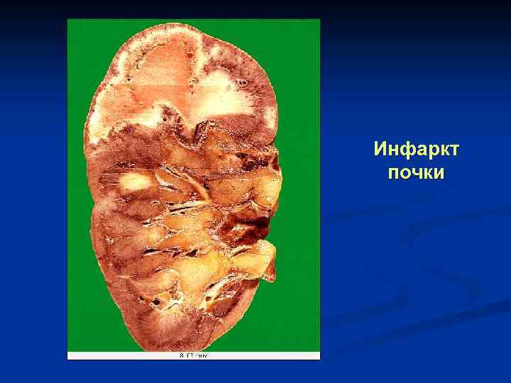 Инфаркт почки 