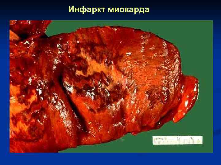 Инфаркт миокарда 