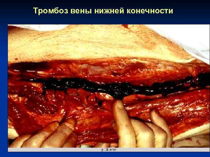 Тромбоз вены нижней конечности 