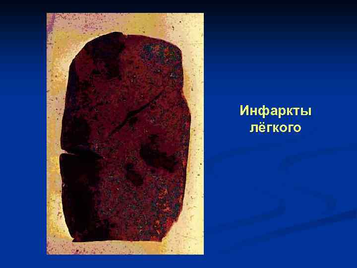 Инфаркты лёгкого 