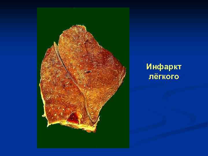 Инфаркт лёгкого 