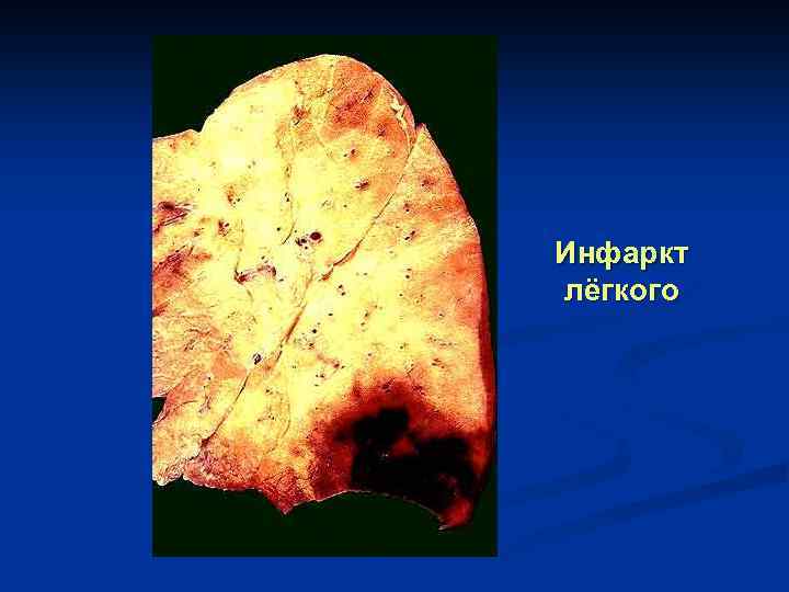 Инфаркт лёгкого 