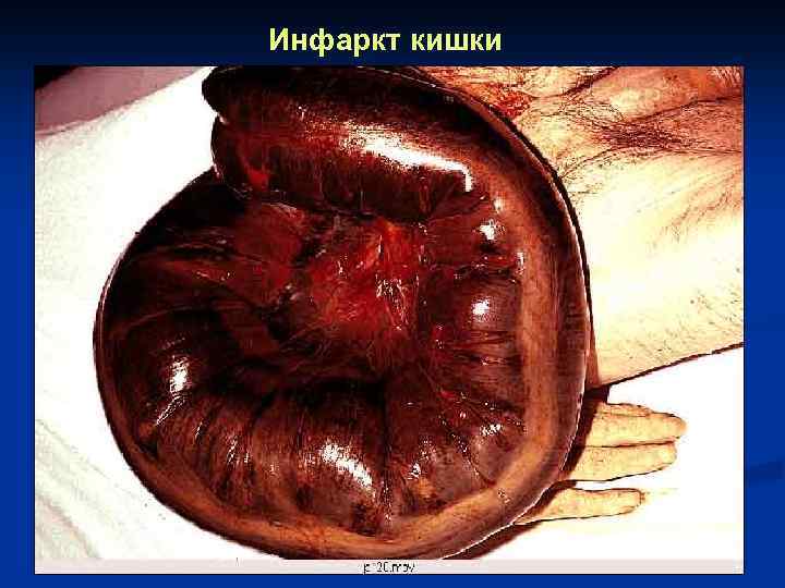 Инфаркт кишки 