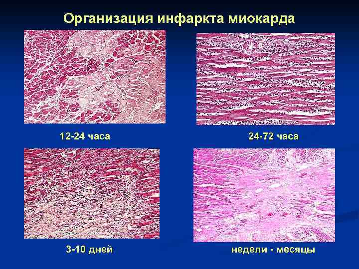Организация инфаркта миокарда 12 -24 часа 3 -10 дней 24 -72 часа недели -