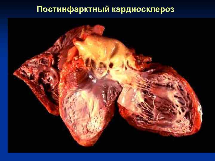 Постинфарктный кардиосклероз 