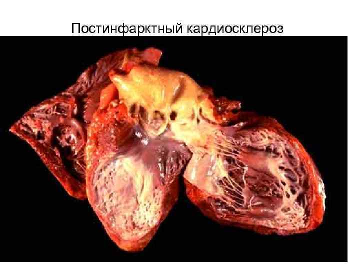Постинфарктный кардиосклероз 