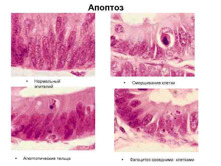 Апоптоз • • Нормальный эпителий Апоптотические тельца • • Сморщивание клетки Фагоцитоз соседними клетками