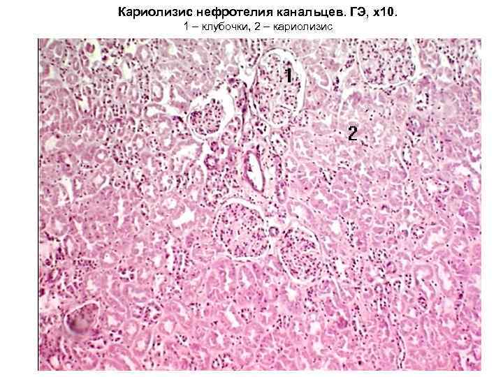 Кариолизис нефротелия канальцев. ГЭ, х10. 1 – клубочки, 2 – кариолизис 
