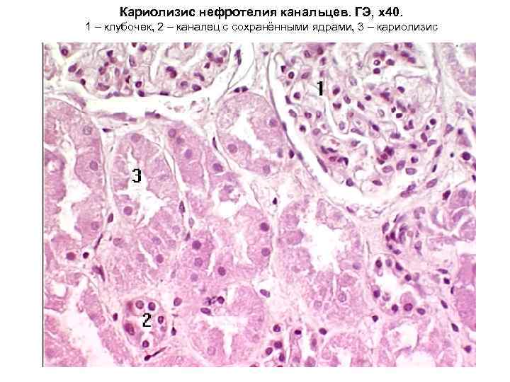 Кариолизис нефротелия канальцев. ГЭ, х40. 1 – клубочек, 2 – каналец с сохранёнными ядрами,