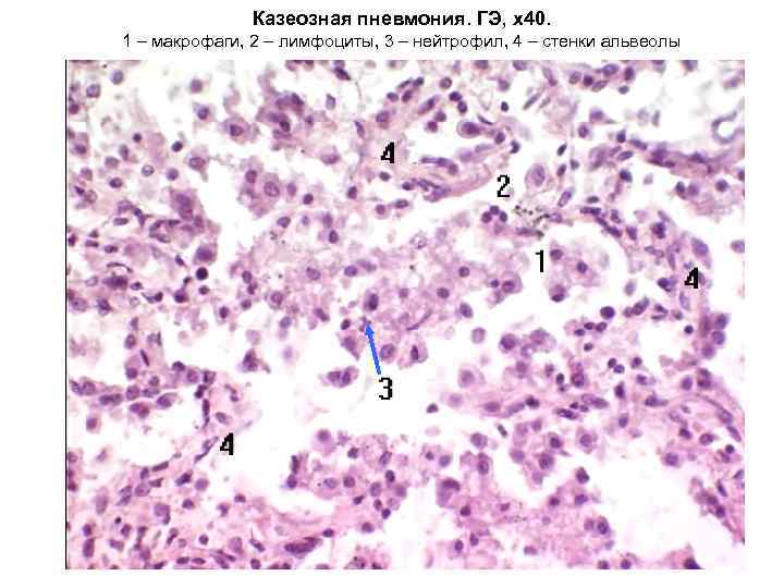 Казеозная пневмония. ГЭ, х40. 1 – макрофаги, 2 – лимфоциты, 3 – нейтрофил, 4