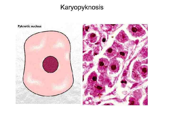 Karyopyknosis 