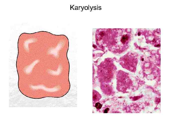 Karyolysis 