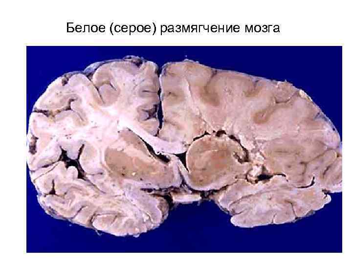 Белое (серое) размягчение мозга 