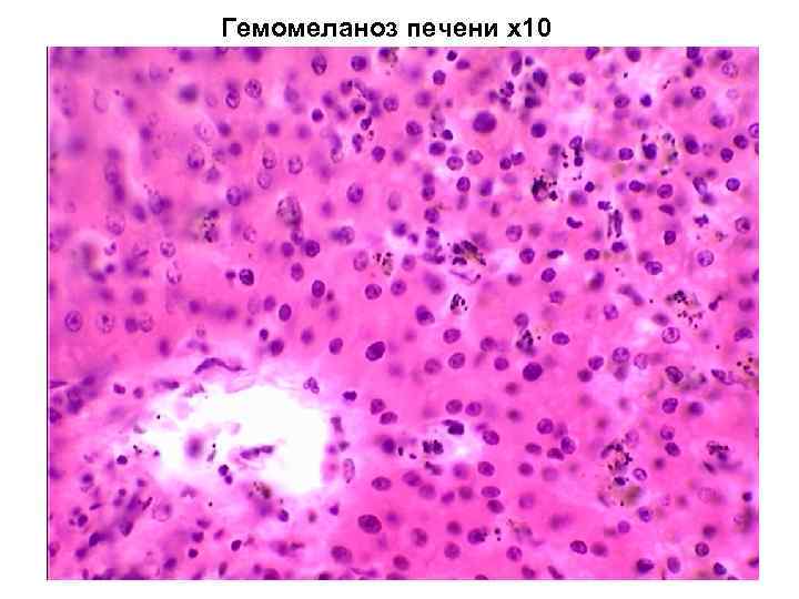 Гемомеланоз печени х10 