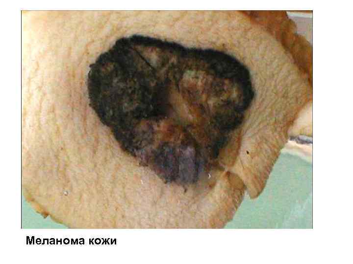 Меланома кожи 