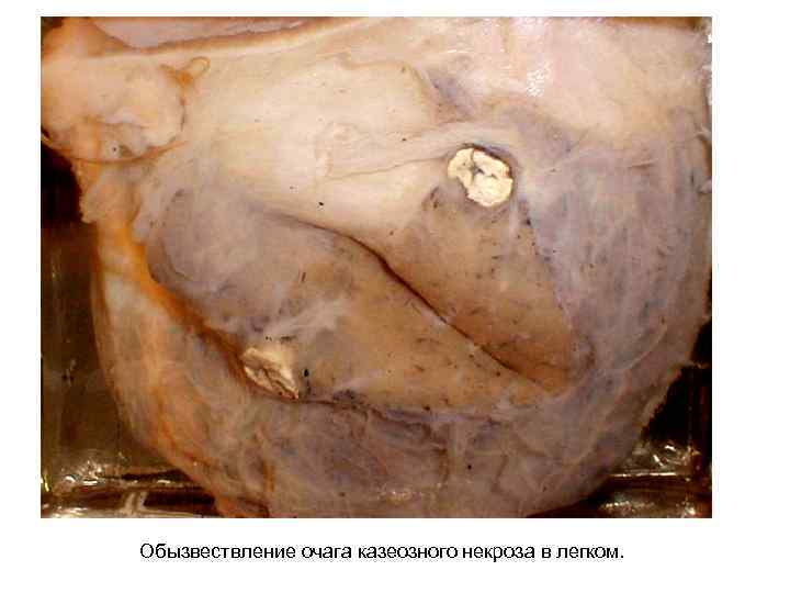 Обызвествление очага казеозного некроза в легком. 