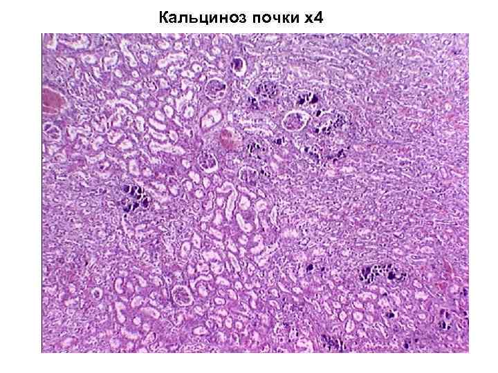 Кальциноз почки х4 