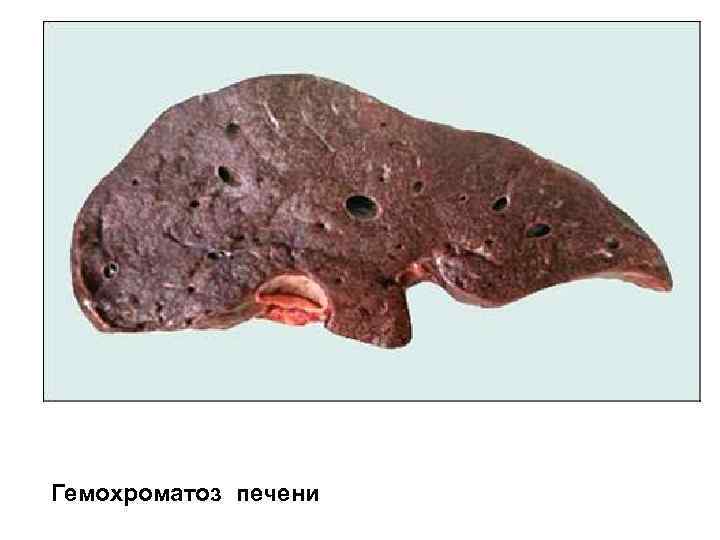 Гемохроматоз печени 