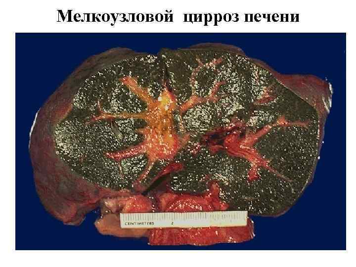 Мелкоузловой цирроз печени 