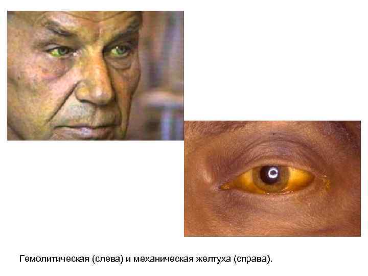 Гемолитическая (слева) и механическая желтуха (справа). 