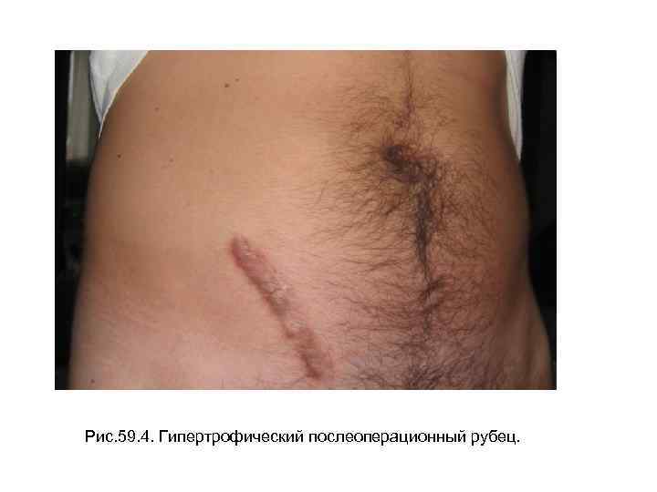 Рис. 59. 4. Гипертрофический послеоперационный рубец. 