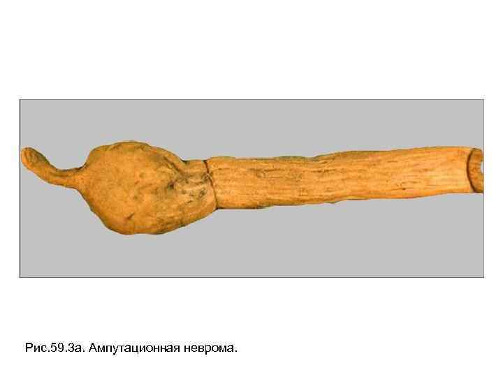 Рис. 59. 3 а. Ампутационная неврома. 