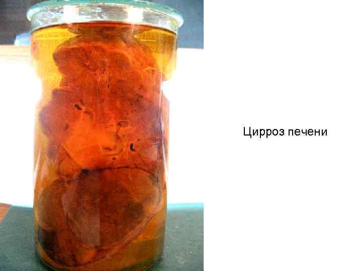 Цирроз печени 