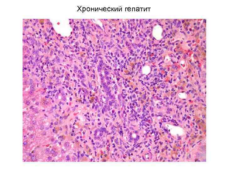 Хронический гепатит 