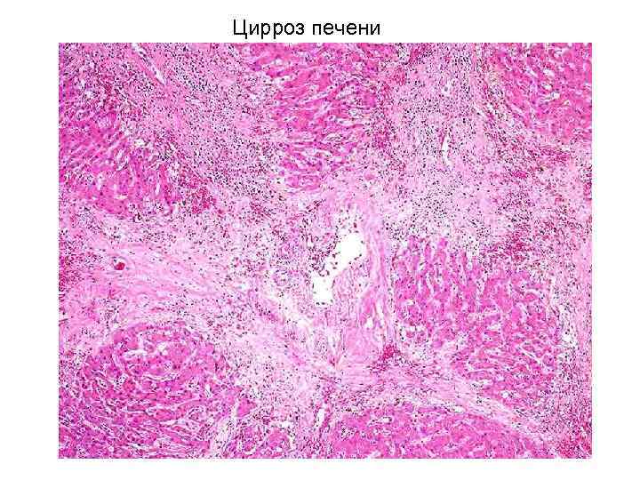Цирроз печени 