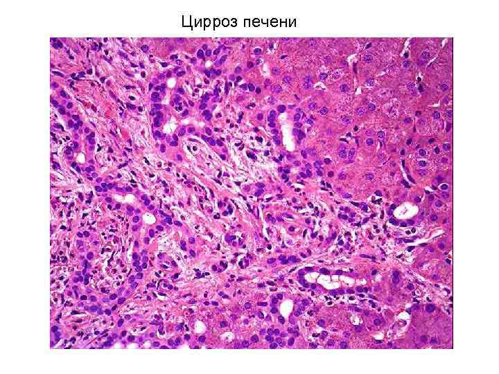 Цирроз печени 