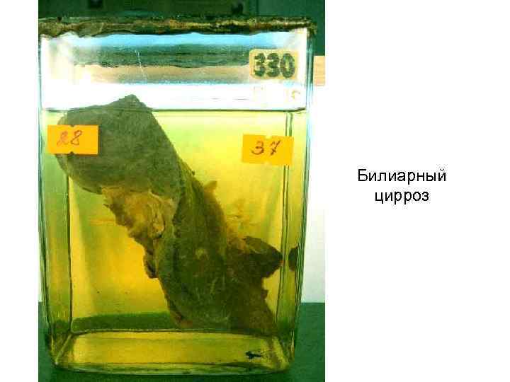 Билиарный цирроз 