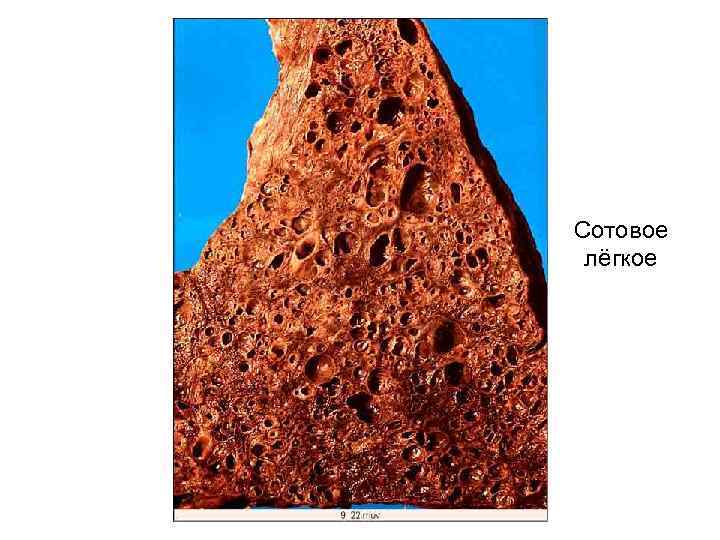Сотовое лёгкое 