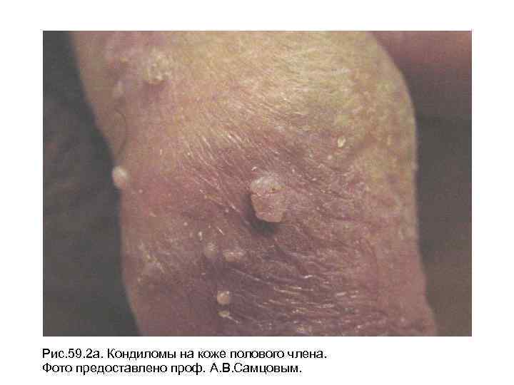 Рис. 59. 2 а. Кондиломы на коже полового члена. Фото предоставлено проф. А. В.