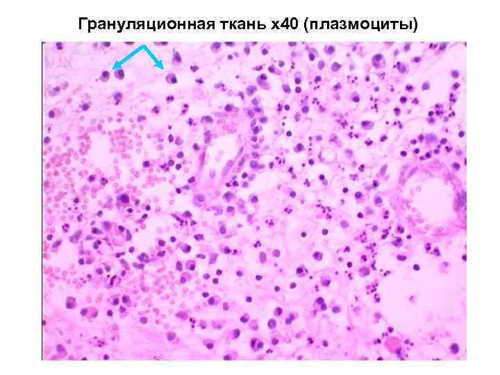 Грануляционная ткань. Грануляционная ткань гистология. Грануляционная ткань микропрепарат. Грануляционная ткань макропрепарат. Губчатая грануляционная ткань.