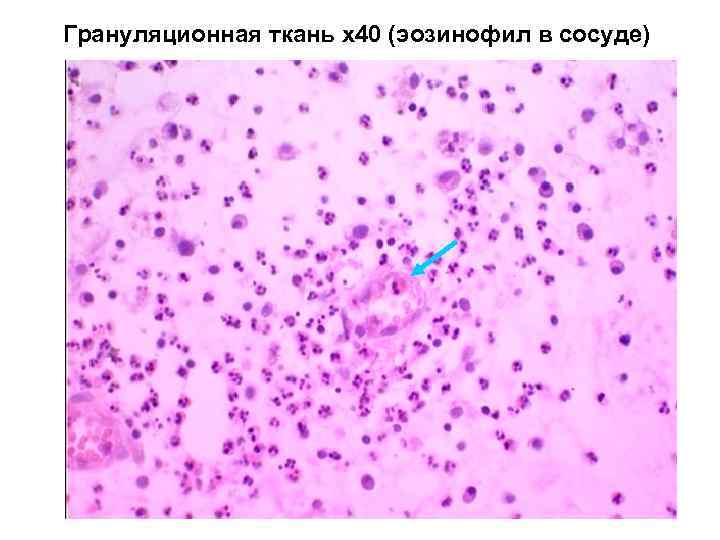 Кондиломы на уздечке полового члена фото